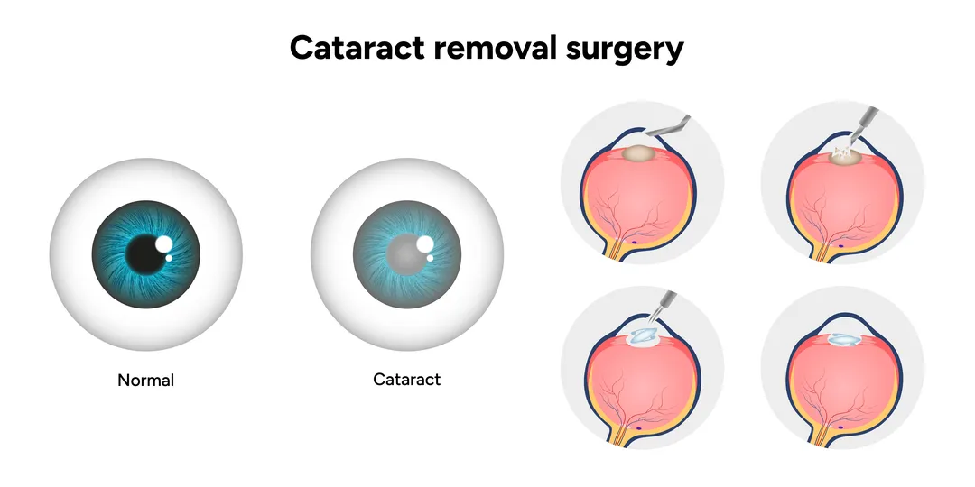 Advanced Cataract Treatment in Patna: How Phaco-Refractive Surgery Brings Back Bright Vision Advanced Cataract Treatment in Patna: How Phaco-Refractive Surgery Brings Back Bright Vision