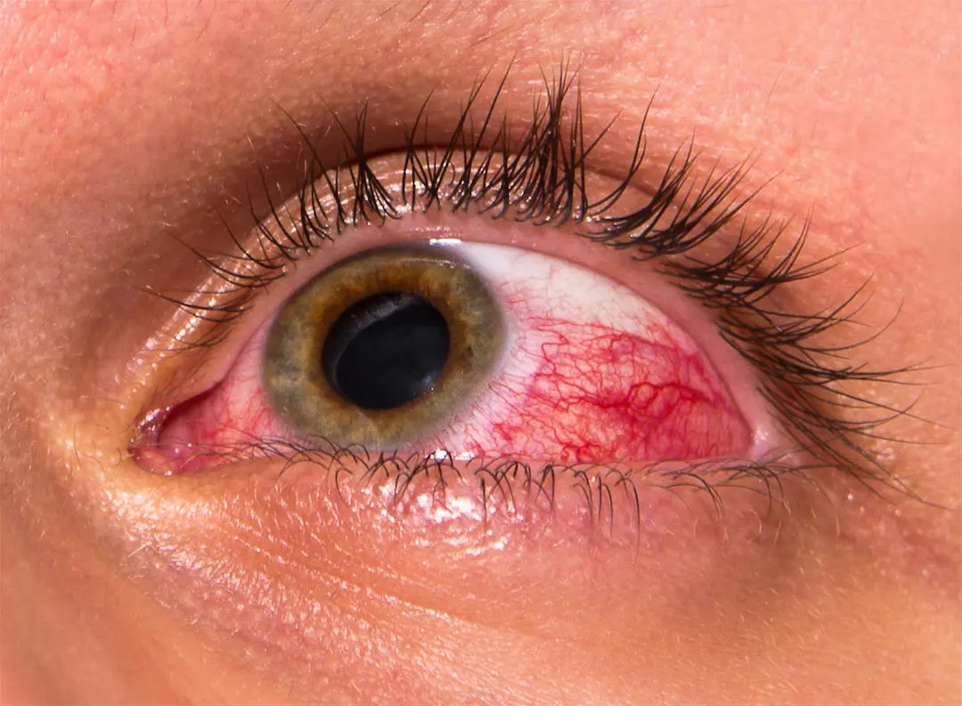 Child experiencing eye allergies, causes, symptoms and treatments