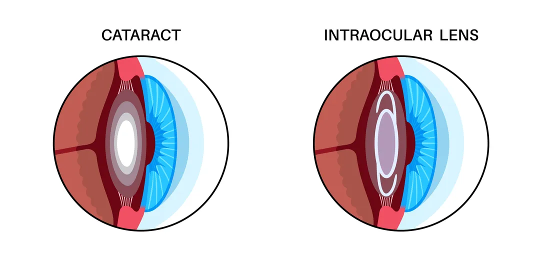 Advanced Cataract Treatment in Patna: How Modern Eye Care is Changing Lives
