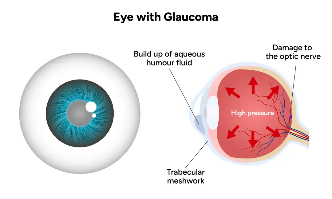 Congenital Cataract and Glaucoma in Children
